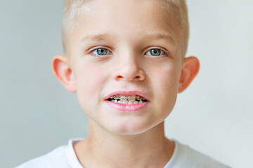 Portrait of a blond 8 year old boy with braces. Pediatric dentistry, orthodontics concept