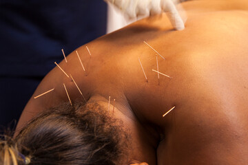 A female patient receiving dry needling therapy from a physiotherapist.