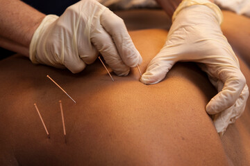 A female patient receiving dry needling therapy from a physiotherapist.