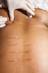 A female patient receiving dry needling therapy from a physiotherapist.