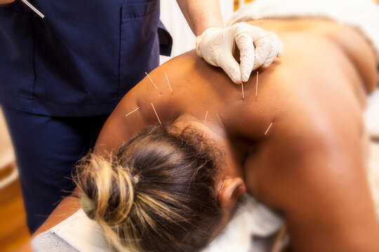A female patient receiving dry needling therapy from a physiotherapist.