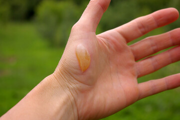 Hand with a burn blister. Man's hand with a fluid-filled covering of skin that forms after a burn. 