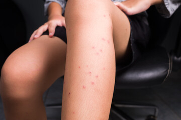 Red allergy pimples on the leg of young girl, caused by mosquitoes bite
