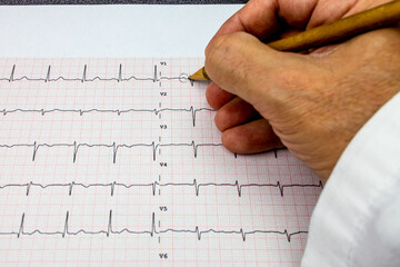 doctor who analyzes an ECG 12 lead and marks the P waves present in the trace with a pencil, close...