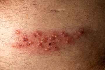 close up of blisters caused by shingles