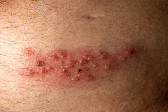 close up of blisters caused by shingles