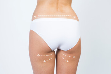 Cellulite removal scheme. White markings on skin legs young woman. - obrazy, fototapety, plakaty