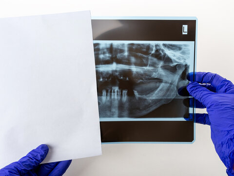 Dentist hands take the panoramic facial x-ray image out of the paper envelope. Original black white x-ray teeth scan of an old person with some lower teeth and no tooth of the upper. Prosthetics.