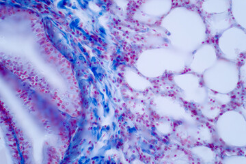 Human lung pathology under light microscope.