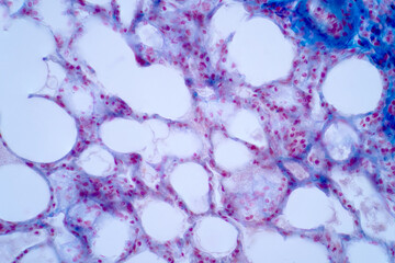Human lung pathology under light microscope.