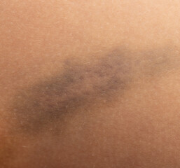 hematoma on the skin as a background
