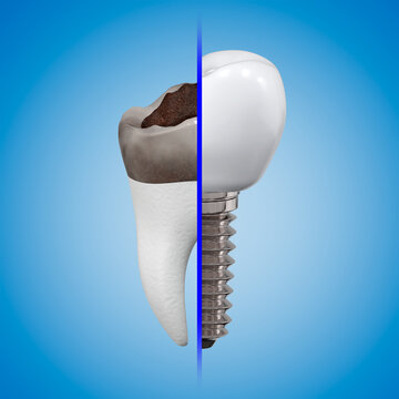 The concept of replacing a damaged tooth with an implant. Carious tooth and implant with a crown. 3d rendering.