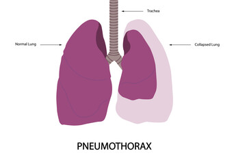 Pneumothorax illustration. Normal lung versus collapsed lung illustration