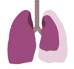 Pneumothorax illustration. Normal lung versus collapsed lung illustration