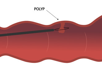 Colon polyp. Colon polypectomy illustration. 