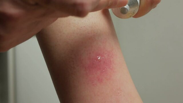 Close-up of an abscess from an insect bite on a woman's leg. A woman treats the wound.