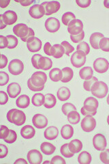 Target cells with abnormal red blood cells in blood smear, specimen from thalassemia patient, analyze by microscope 1000x
