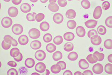 Target cells with abnormal red blood cells in blood smear, specimen from thalassemia patient,...