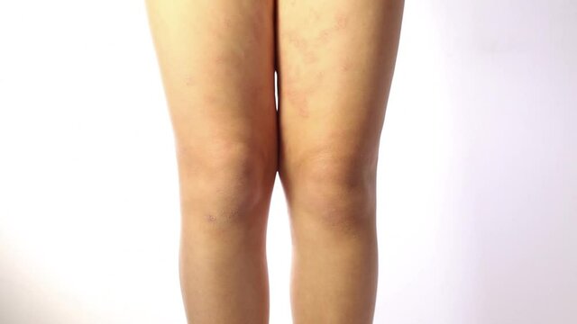 Severe atopic eczema on the legs of a child is a dermatological disease of the skin. Large, red, inflamed, scaly rash on the legs. Legs of a teenager with severe atopic dermatitis.Close-up