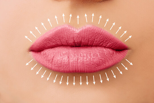 Lip augmentation. Fillers. Beautiful perfect pink lips
