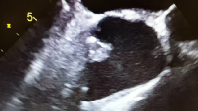 Echocardiogram showing vegetation on a pacemaker wire