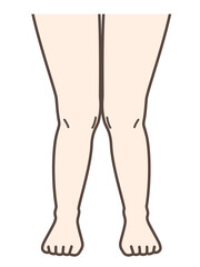 X脚、膝の病気の解説用イラスト
