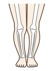 XO脚、膝の病気の解説用イラスト