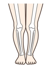XO脚、膝の病気の解説用イラスト