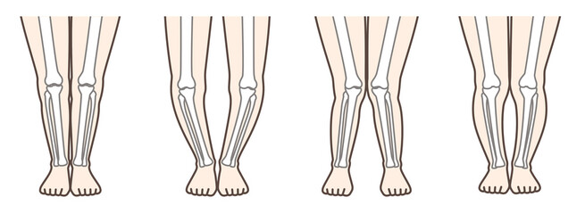 変形性膝関節症　図解