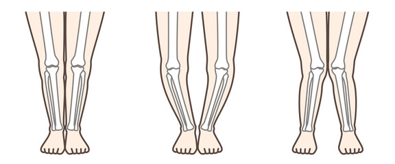 変形性膝関節症　図解