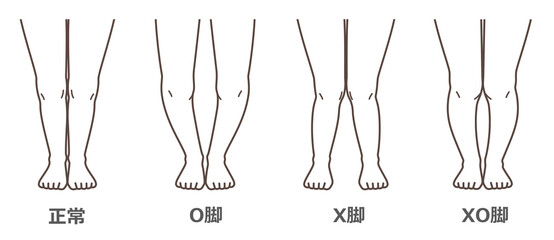 変形性膝関節症　図解