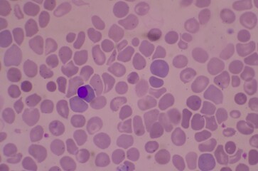 Nucleated Red Blood Cells ( NRC) in blood smear.