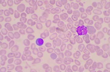 Nucleated Red Blood Cells ( NRC) in blood smear.