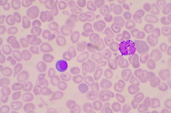 Nucleated Red Blood Cells ( NRC) in blood smear.