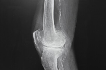 x ray image of knee. X-ray of the knee joint, x-ray shown calcific of vascular. Healthcare and...