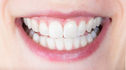 Concept of healthy smile with medically treated teeth. White smile with healthy teeth. Smile after...