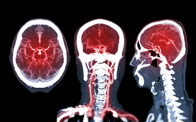 Collection of CTA brain or CT angiography of the brain  comparison Mip technique Axial ,Coronal and Sagittal view for detect brain anueurym.
