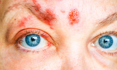 Shingles on the Face and Around the Eye of a Woman, Called ophthalmic herpes zoster or herpes...