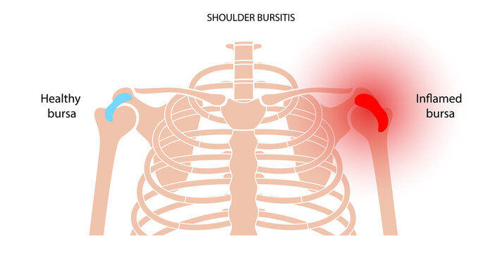 Bursitis inflammation concept