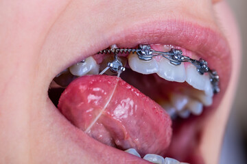 Close up of orthodontist hands putting elastic rubber band on patient brackets.