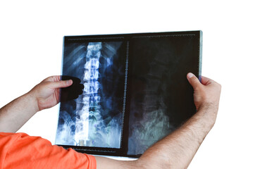 hands of a male doctor examine an X-ray of the lumbar-spinal joint, health care and radiography