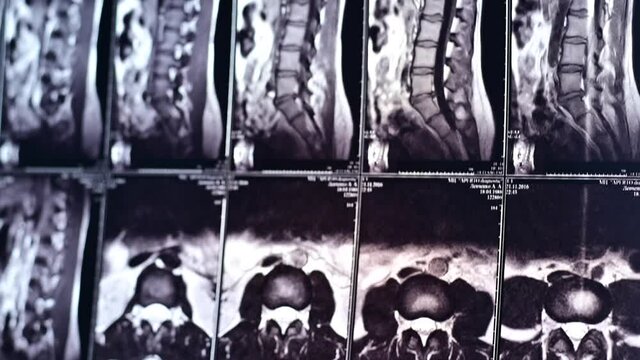 Magnetic resonance imaging of the lumbar spine.
