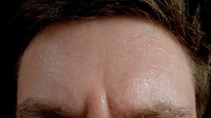 Forehead of very sweating adult young man - 438291764