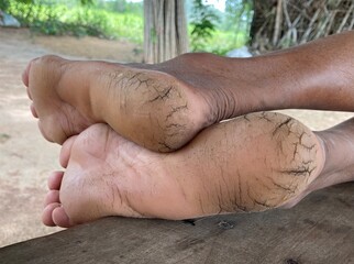 Woman dried and cracked heels.