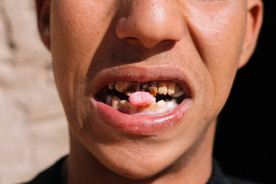 Ethnic person with bad teeth eating candy