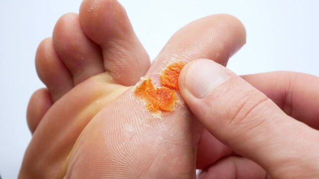 Contagious skin illness on foot. Medical treatment footage. Close up video of plantar wart on man's foot. Salicylic acid plaster. Remove Verruca plantaris.