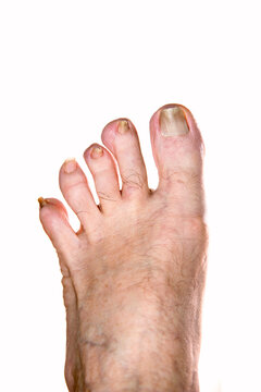 Close up of an elderly man's foot with some nail diseases. Medical examination.