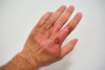 new skin on the hand after a burn, healing burn on the body