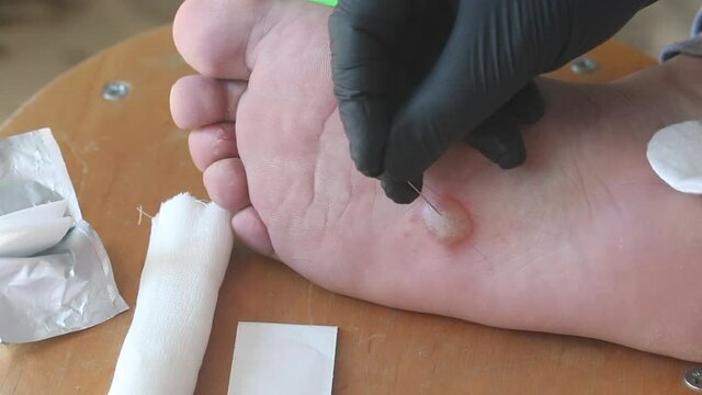 Dyshidrotic eczema on the foot, dermatitis. The man pierces the bubble with a needle. Close-up shot.