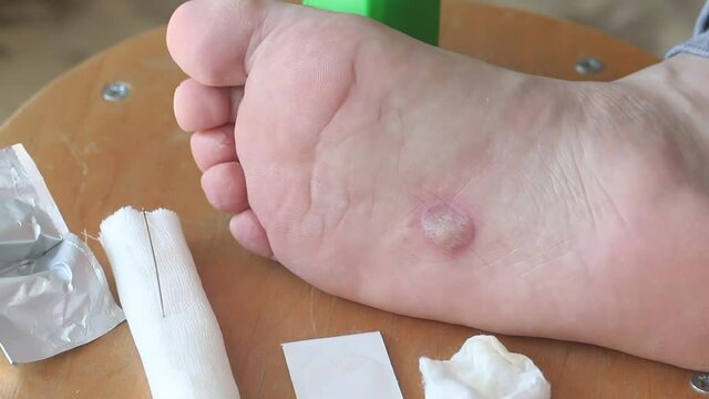 Dyshidrotic eczema on the foot, dermatitis. A man dabs a deflated bubble with an alcohol napkin. Close-up shot.
